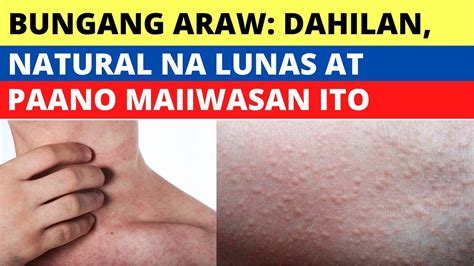 bungang araw na may nana paano mawala
